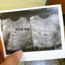 [순자의 난임일기 12] 시험관 동결 이식 후 임신 5주~7주 그리고 계류유산 후기