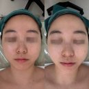 첫마을7단지702동앞 | 용인 수지 피부관리 추천 올가드림뷰티 신정마을점 모공디톡스 비포애프터 후기