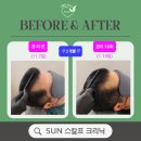 광교 탈모관리 후기ㅣ남성 M자 헤어라인 탈모