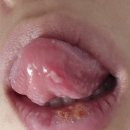 푸른약품 | 임산부가 화상을 입는다면? 입술, 입안 화상 치료 대구 푸른병원/ 한미약품 프로캄 립에센스 사용후기