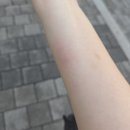 한강수병원 | 서울 화상전문병원 후기 / 한강수병원