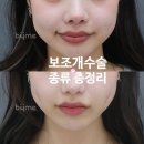 더(The)예쁜얼굴만들기성형외과의원 | 보조개 시술 종류 총정리｜연예인 보조개 차이와 위치 (성형외과 전문의 설명 aka. 보조개 왕자)