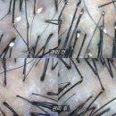 솔고건강센터중앙지점 | 평택 탈모관리 유명한 곳 WT메소드평택점 두피관리 후기