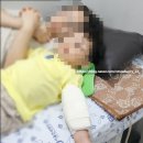 연세어린이집 | [3살아이 얼굴 봉합수술 후기] 서울연세병원 성형외과 – 수면마취·6바늘 봉합·흉터관리