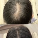 힐링약국 | 남자 여자 약국 탈모샴푸 내돈내산 후기 탈모완화 홈케어 추천템