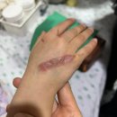 푸른별유치원 - 2032 | [어린이 화상 치료 후기-2] 심재성 2도 화상, 화상 초기 주의 사항, 인덕원 평촌 푸른외과의원