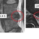 Sims 님의 요추디스크 L4-5의 MRI사진 판독입니다. [3급 판정] 이미지