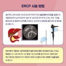 ERCP(내시경적 역행성 담췌관 조영술)이란 무엇일까요? 이미지