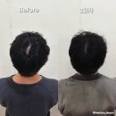 2369 | 강남 두피 문신 다롬 SMP 자연스럽게 이뻐진 남자 정수리 가르마 커버 후기