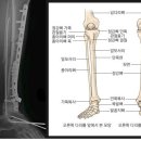 경골비골의 후유장해, 경골골절, 비골골절 교통사고합의금산정 이미지