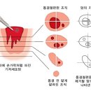 기저세포암의 치료방법 이미지