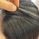 지성농장 | 두피 관리 추천, 스케일링 후기 (지성두피 필수) / 30대 비듬부자 나야나 ~ .. 나야나 ..