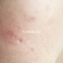물결한의원 | 구로구 피부과 한의원에서 여드름패인흉터 제거 후기, 새살침 치료 2회 3회차