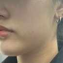 클림의원 | [명동역] 클림의원 티타늄 리프팅 후기 – 효과, 통증, 관리법까지!