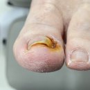파주내성발톱 고민 해결! 닥터페디&amp;네일투게더에서 청결하고 세심하게 케어