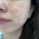 독일의원 | &lt;내돈내산&gt; 미올린의원 용인점 :: 시그니처 스킨부스터+리쥬란힐러2CC+릴리이드 + PHA 물광필 후기