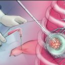 미국에서의 폐 고주파 절제술 (Lung Radiofrequency Ablation, Lung RFA) 사례 이미지
