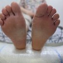 레푸스 구월점 내성발톱 무좀발톱 발각질 문제성발 이미지