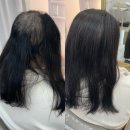 여성의집 | 모자 없이 외출하고 싶던 발모벽 여성의 증모술 리얼 후기