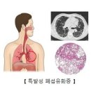 특발성 폐섬유화증 (Idiopathic pulmonary fibrosis) 이미지