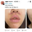 쓰레드에서 핫한 인중축소 성형수술 피해자...jpg 이미지