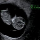 온산의원 | 임신 9주차 5일 초음파 아기크기 심박수 확신의 기차 심장소리,,