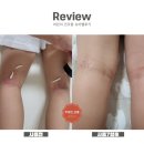 인셀덤 바디크림 어린이 건선 후기(놀라지 마세요~)