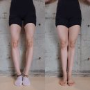내 삶도 글이 될까요? | 저도 윤아 오다리처럼 진짜 교정이 될까요? (실제 사례로 알아보기)