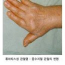 손가락관절 통증의심해야 할 은 이미지