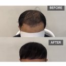 수정헤어디자인 | 울산 달동 헤어 증모술 원탑 - 디어바이주 수정원장님 추천