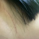 고대의원 | 강남 땡큐서울의원 이하선종양 수술 실비 후기 / 6개월 경과