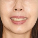 성남수진동치과 돌출 앞니 2D 부분 교정 및 임플란트까지 해드렸습니다.