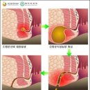 무한도전 노홍철의 &#39;찌루찌루&#39; 방치하기엔 너무 고통스러워 (치루사진有) 이미지