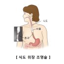 식도이완불능증(Esophageal Achalasia) 이미지