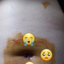 파티마성형외과 | 대구 파티마병원 성형외과 감염 내과, 켈로이드 흉터제거, 표피 낭종 치료 후기(1)