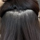 멍멍헤어 | 서울 압구정 여성 헤어라인 비절개 모발이식(2,300모) 일주일 후기