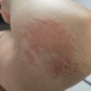 하님약국 | 팔뚝 무한람스 내돈내산::당일시술한 쌉P의 찐 후기 3주차:: 2번째 오렌지케어, 부작용?, 멍, 붓기...