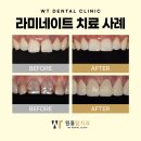 원흥탑치과의원 | 원흥치과 라미네이트로 밝은 인상 변화