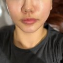 압구정피부과 온다리프팅 후기! 다운타임 걱정 없이 관리받고 온 솔직 후기