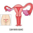 골반염[pelvic inflammatory disease] 질환이란? 이미지