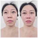 부산 정관 작은얼굴 윤곽 리프팅관리 에스테틱썬플 예신비대칭관리 후기