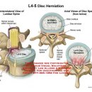 척추전위증 (Spondylolisthesis) 이미지