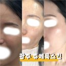 샤인성형외과의원 | 광주 피부과 쥬베룩스킨 스킨부스터 솔직후기｜환절기피부관리·피부재생·여드름흉터 효과까지
