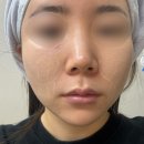 신논현피부과 슈링크유니버스 효과, 통증 찐 후기