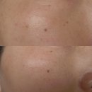 심해진 | 리쥬란 힐링 마스크팩 후기 기미 심해진 피부 관리 비법