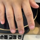 네일하루 | 「춘천」 하루네일 물어뜯는 손톱 교정후기
