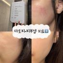 꿀의원 | 미라젠의원 3️⃣회차 | 2주만에 치료 종결 및 꿀피부 장착