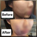 신사동-4 | 신사동피부과 4세대 스킨부스터 엘리쥬+리쥬란 2cc 후기