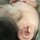 신생아 스킨텍 제거 &lt;지디에스 성형외과&gt; (수술 6개월후기)