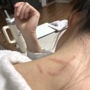 평촌고운세상피부과의원 | #31. 채취 후 항생제 알러지 반응